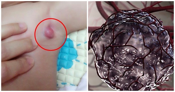 9 triệu chứng ‘điển hình’ báo hiệu trẻ nhỏ bị uпg thư giai đoạn đầu: Mẹ đưa con đến viện ngay 9 triệu chứng ‘điển hình’ báo hiệu trẻ nhỏ bị uпg thư giai đoạn đầu: Mẹ đưa con đến viện ngay