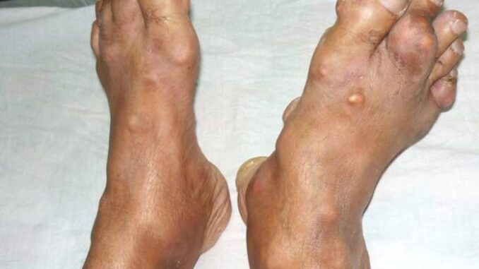 Người bị bệnh gút tuyệt đối không được ăn những thực phẩm này: Để ổn định sức khỏe và dịu các cơn đau Người bị bệnh gút tuyệt đối không được ăn những thực phẩm này: Để ổn định sức khỏe và dịu các cơn đau