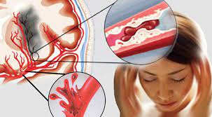 Vợ kêu đau đầu rồi ngủ, ngừng thở qua đời chồng không biết: 1 kiểu đau đầu cần đi viện ngay đừng chần chừ Vợ kêu đau đầu rồi ngủ, ngừng thở qua đời chồng không biết: 1 kiểu đau đầu cần đi viện ngay đừng chần chừ