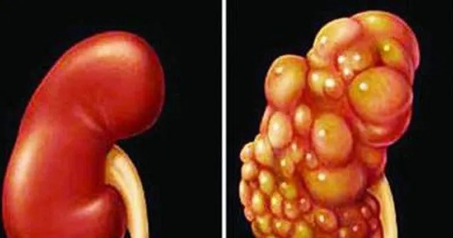 Những dấu hiệu âm thầm của u-ng thư thận dễ bị bỏ qua