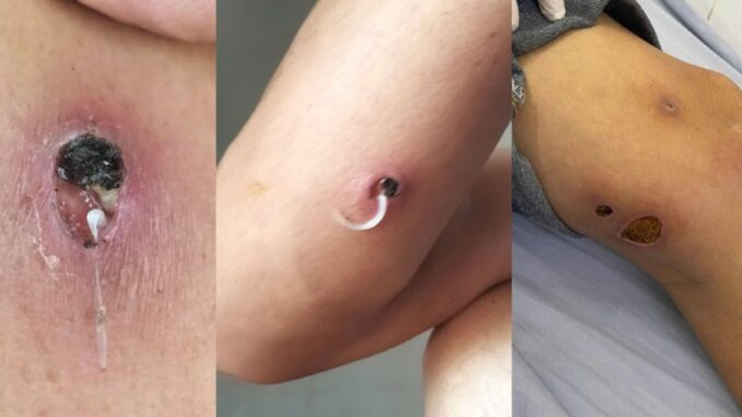 Cảnh báo căn bệnh hiếm gặp xuất hiện ở Việt Nam Cảnh báo căn bệnh hiếm gặp xuất hiện ở Việt Nam