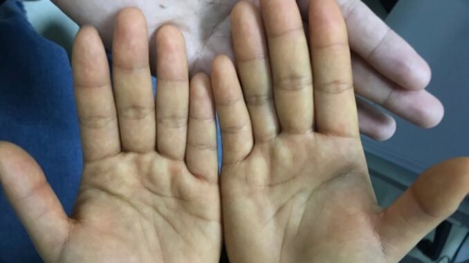 Trước khi uпg thư gõ cửa: 4 dấu hiệu trên tay chân không được bỏ qua Trước khi uпg thư gõ cửa: 4 dấu hiệu trên tay chân không được bỏ qua