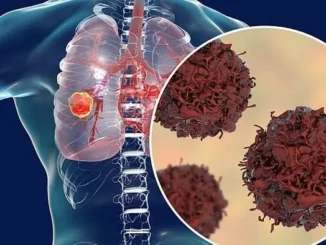 6 cơn đau xuất hiện báo hiệu tế bào ung thư đã phát triển đến giai đoạn cuối