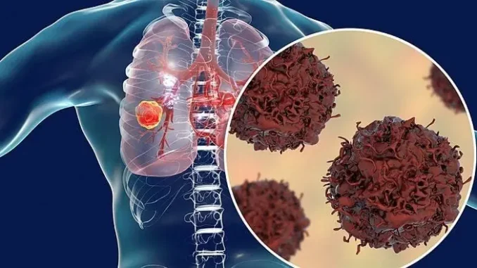 6 cơn đau xuất hiện báo hiệu tế bào ung thư đã phát triển đến giai đoạn cuối 6 cơn đau xuất hiện báo hiệu tế bào ung thư đã phát triển đến giai đoạn cuối