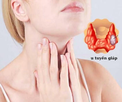 Số lượng u tuyến giáp ngày càng tăng nhanh, bác sĩ khuyên nên ăn ít hơn loại thực phẩm này Số lượng u tuyến giáp ngày càng tăng nhanh, bác sĩ khuyên nên ăn ít hơn loại thực phẩm này