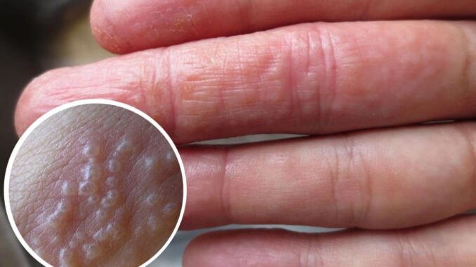 Tay mọc mụn nước li ti có sao không?