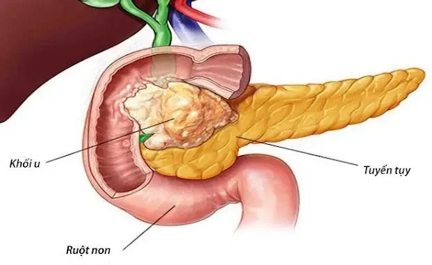 UT lúc đầu không đa:u nhưng thấy 8 dấu hiệu khi đi vệ sinh thì nên đi khám sớm: Đừng chủ quan