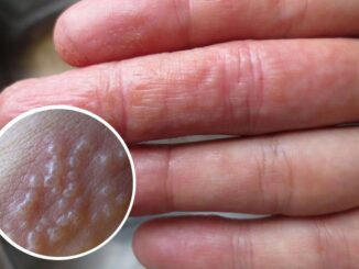 Tay mọc mụn nước li ti có sao không?